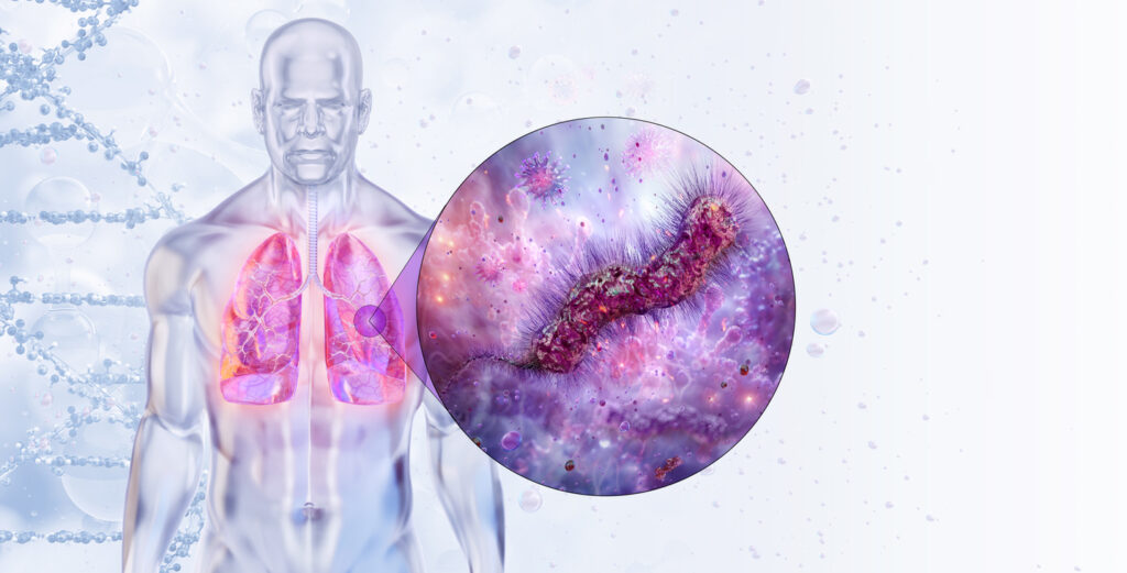 A photo of legionella lung disease cause by Legionella and Water Borne Pathogen